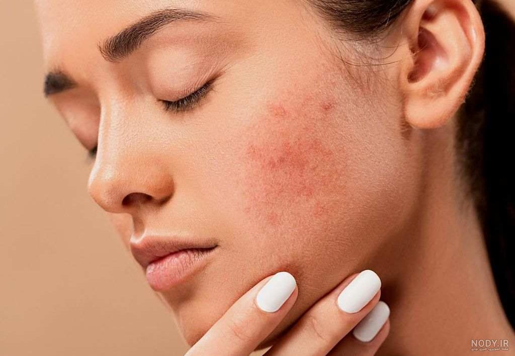 انواع جوش های صورت و درمان آن - کلینیک پوست و مو ساعی انواع جوش های صورت و درمان آن - کلینیک پوست و مو ساعی