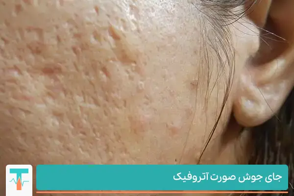 جوش صورت چیست؟ علت و انواع آن، و روشهای جلوگیری و درمان جوش صورت چیست؟ علت و انواع آن، و روشهای جلوگیری و درمان