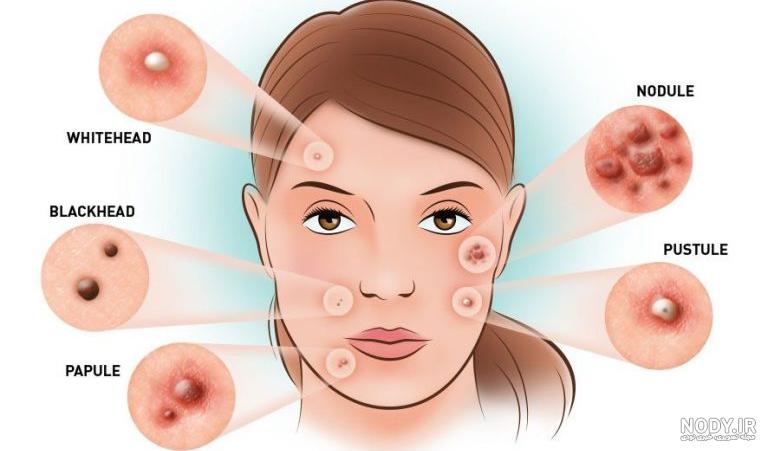 شناخت جوش صورت همراه با تصاویر| معرفی انواع جوش ها شناخت جوش صورت همراه با تصاویر| معرفی انواع جوش ها