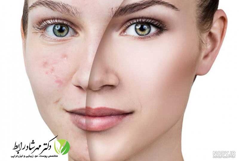 عکس انواع جای جوش عکس انواع جای جوش