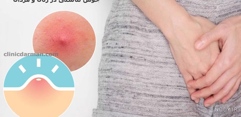 عکس انواع جوش های صورت عکس انواع جوش های صورت