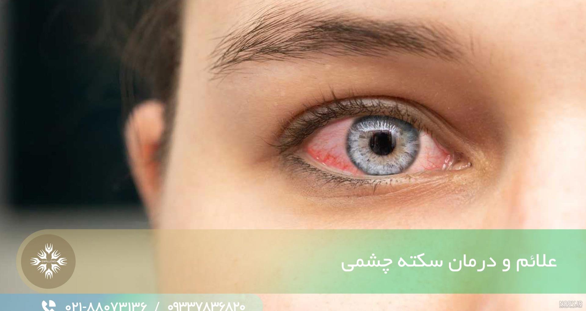 مهم ترین علت زردی چشم - درمان زردی چشم - بیماری های ژنتیکی عامل زردی چشم