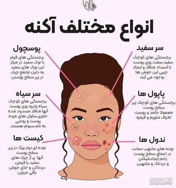 هر آن چیزی که باید درباره انواع جوش صورت بدانید... هر آن چیزی که باید درباره انواع جوش صورت بدانید...