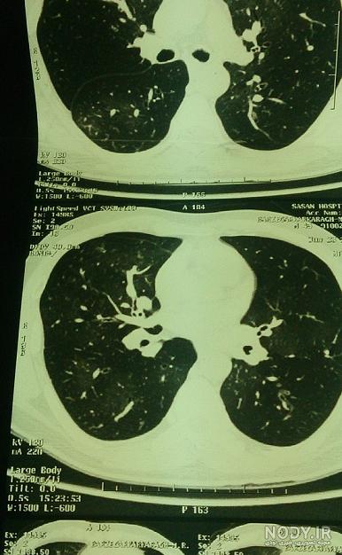 سی تی اسکن ریه با پیشرفته ترین دستگاه دنیا - مرکز جامع تصویربرداری پزشکی  اکسین اهواز
