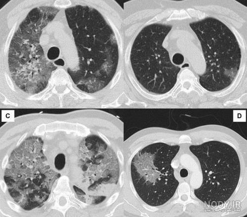 سی تی اسکن ریه برای بیمار کرونایی چه زمانی لازم است؟ - مجتمع جامع پزشکی صدر