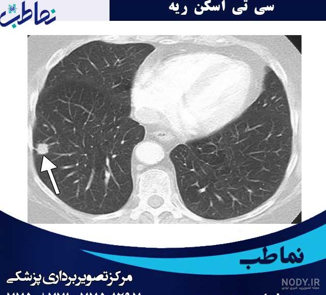 سی تی اسکن ریه چیست و چرا انجام می شود؟ | مرکز تصویربرداری دکتر قائمیان