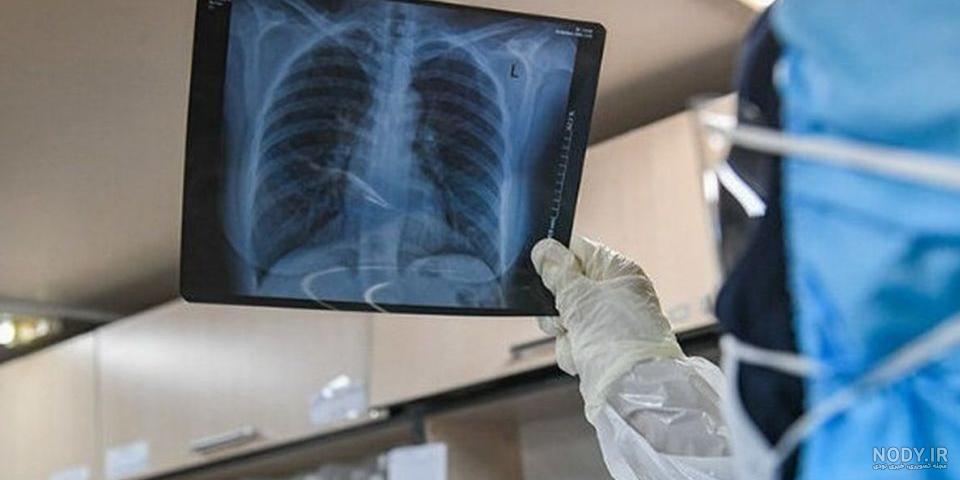 عکس ریه ای که درگیر کرونا شده