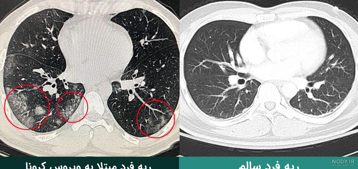 عکس سی تی اسکن ریه سالم و کرونایی