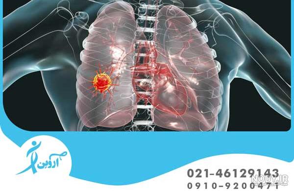 گالری تصاویر سی تی اسکن ریه در بیماران مبتلا به کرونا ویروس کووید-19 |  ویترین مد