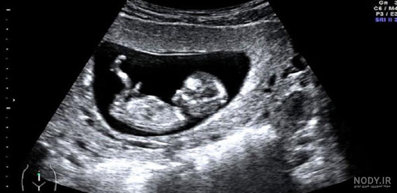 عکس برگه سونوگرافی جنین دختر