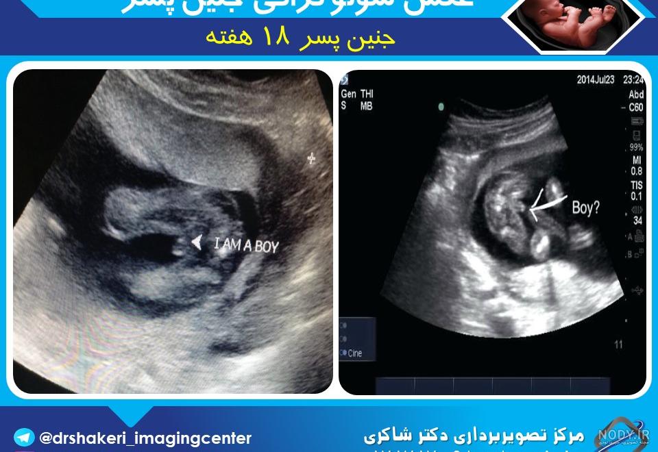 عکس برگه سونوگرافی جنین دختر