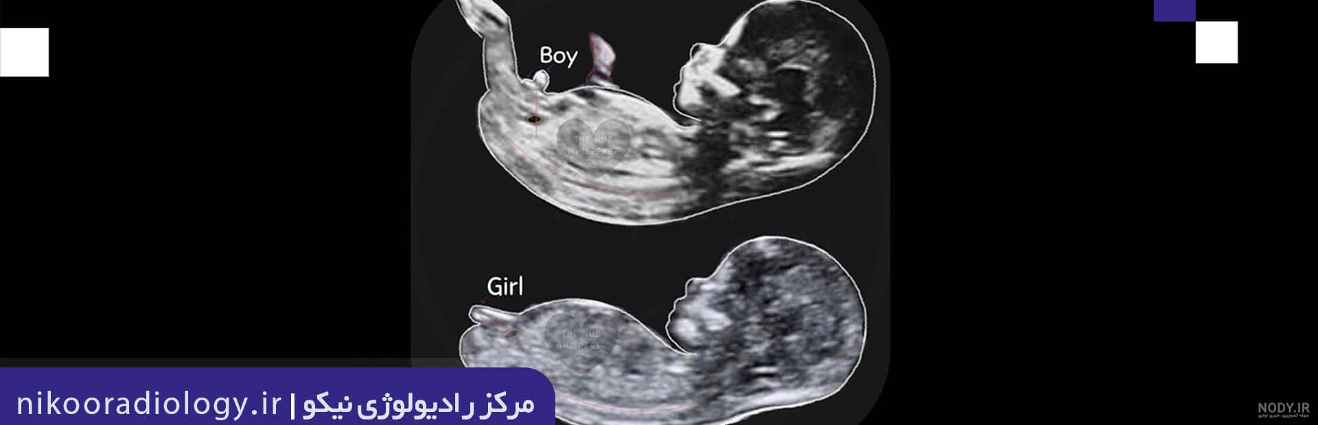 عکس خفن عکس سونوگرافی پسر