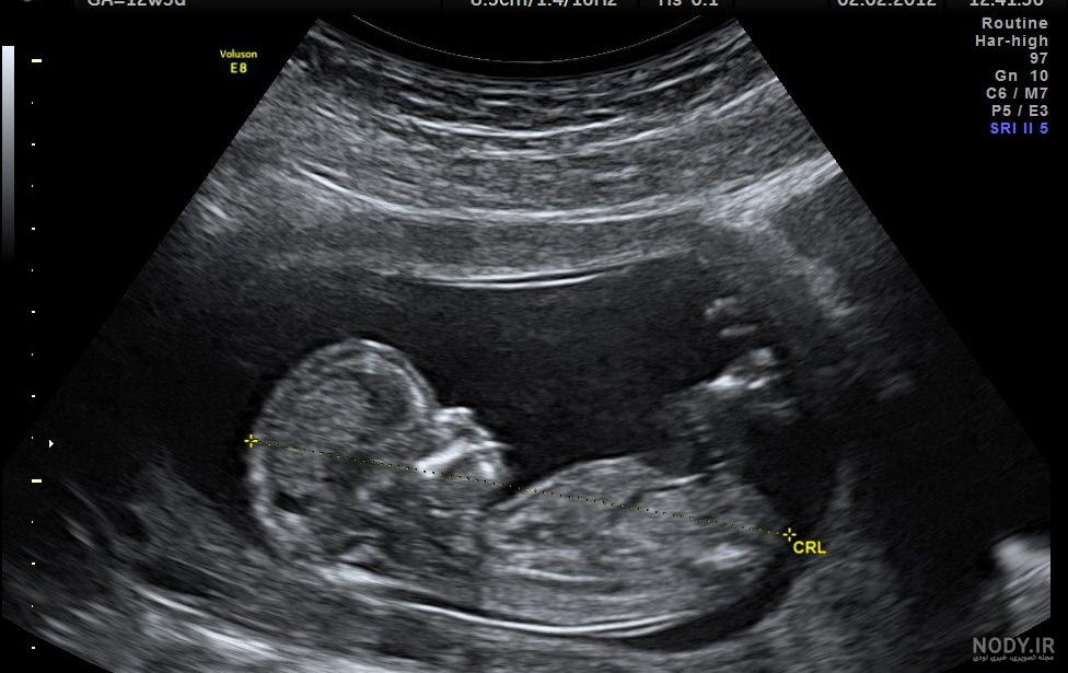 عکس خفن عکس سونوگرافی پسر