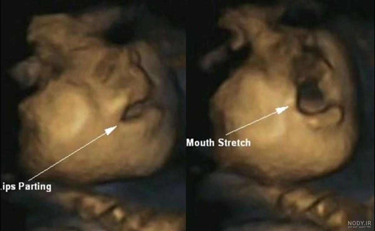 عکس برگه سونوگرافی جنین دختر