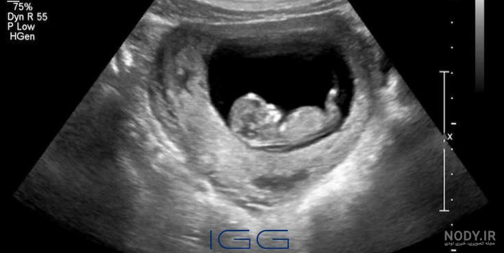 عکس برگه سونوگرافی جنین دختر