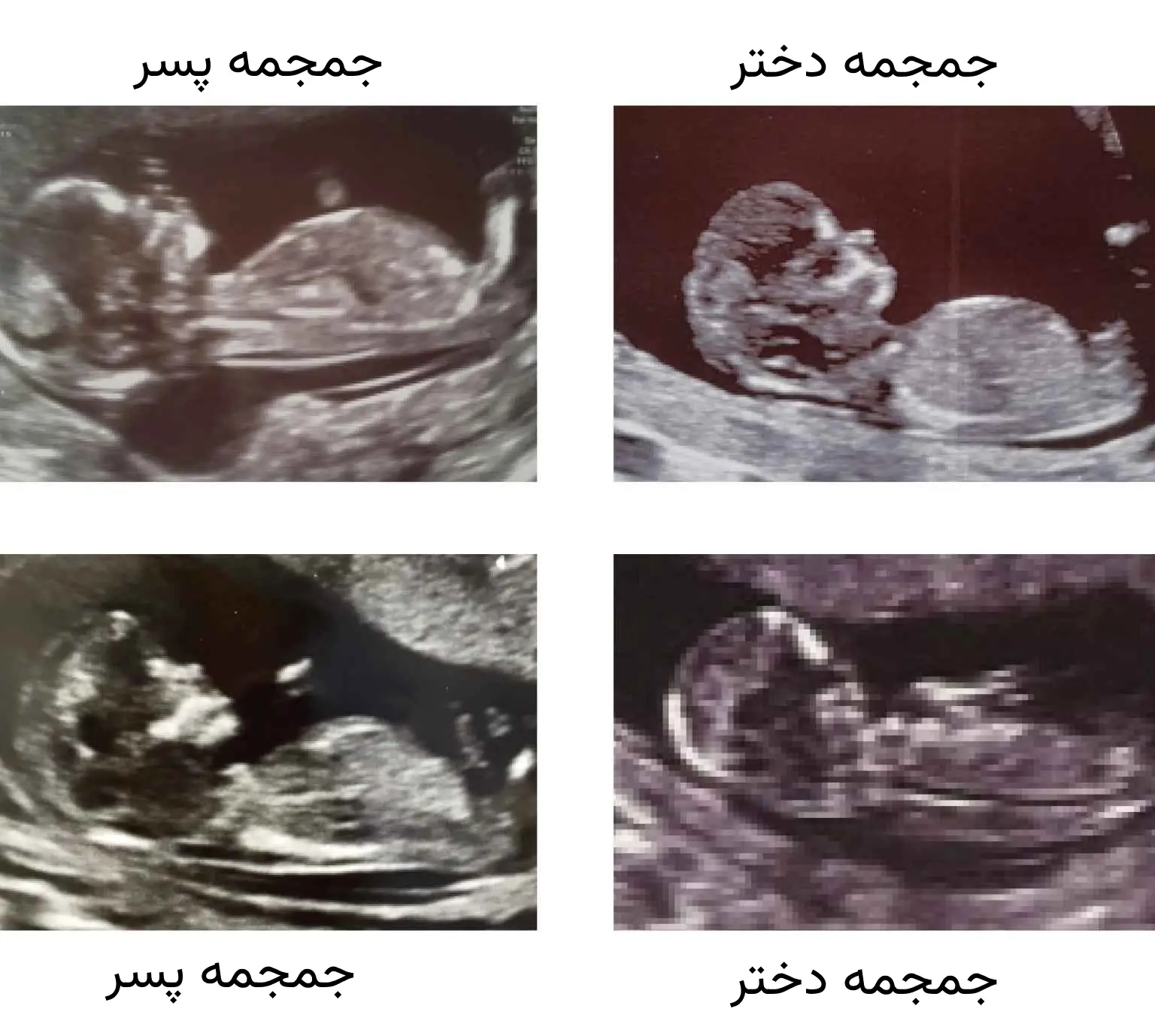 عکس برگه سونوگرافی جنین دختر