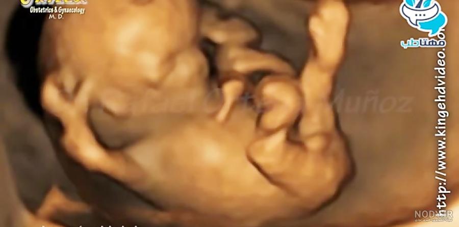 عکس برگه سونوگرافی جنین دختر