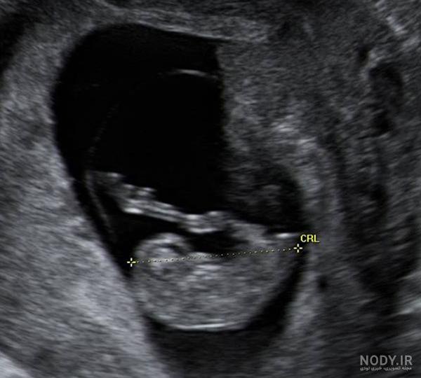 عکس برگه سونوگرافی جنین دختر