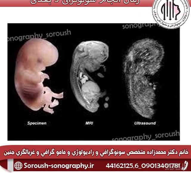آناتومی رحم - پینو بیبی آناتومی رحم - پینو بیبی