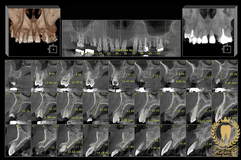 عکس CBCT دندان چیست و چه زمانی نیاز است؟ - دکتر مهناز ارشد عکس CBCT دندان چیست و چه زمانی نیاز است؟ - دکتر مهناز ارشد