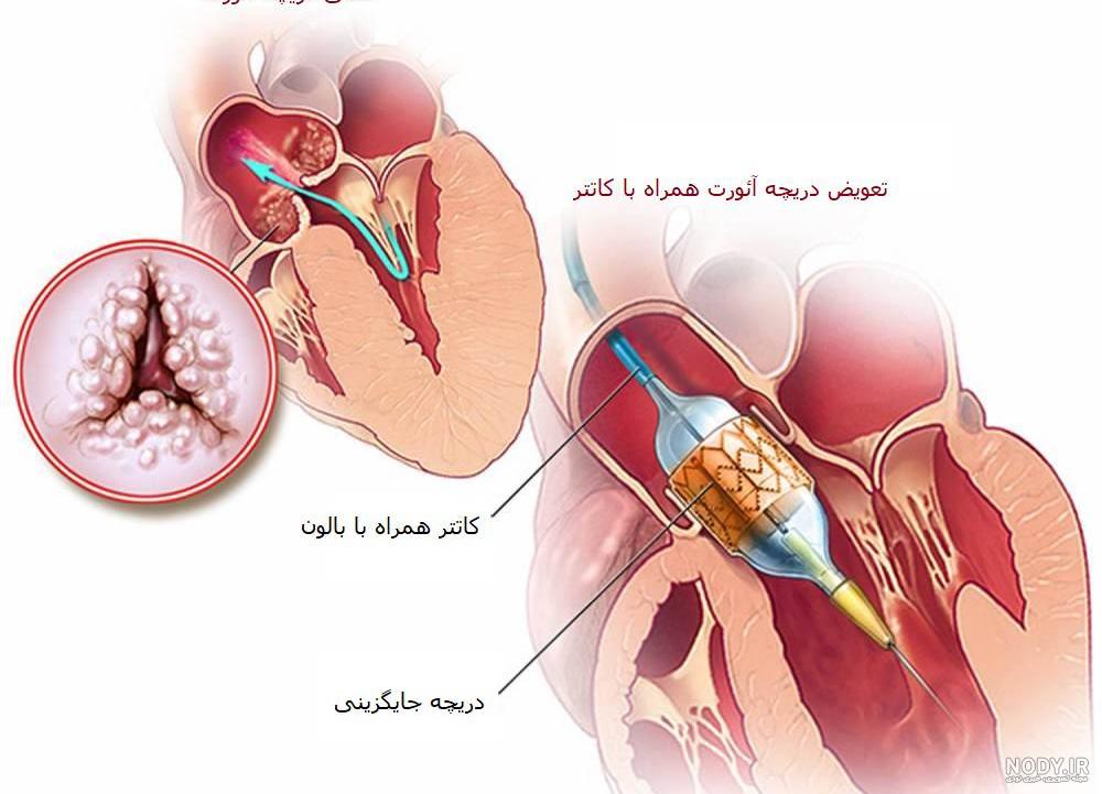 بارداری با دریچه مصنوعی قلب چه عوارض و خطراتی دارد؟ | نی نی پلاس بارداری با دریچه مصنوعی قلب چه عوارض و خطراتی دارد؟ | نی نی پلاس