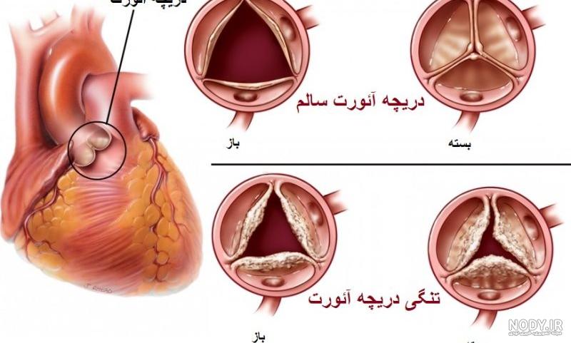 تنگی دریچه آئورت روش تشخیص و درمان | پذیرش۲۴ تنگی دریچه آئورت روش تشخیص و درمان | پذیرش۲۴