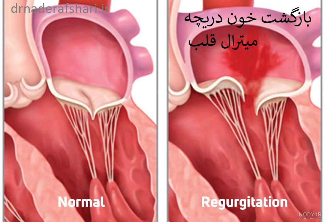 دانسته هایی از دریچه ‏های مصنوعی قلب