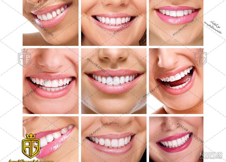 زیبایی و طرح لبخند | هزینه اصلاح طرح لبخند | کلینیک دندانپزشکی آلما زیبایی و طرح لبخند | هزینه اصلاح طرح لبخند | کلینیک دندانپزشکی آلما