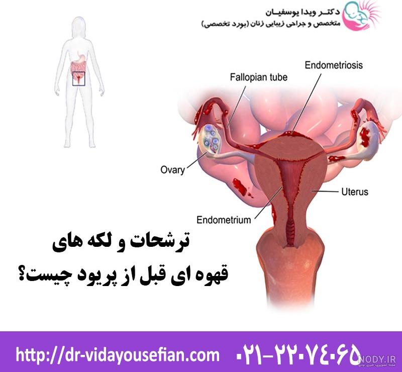 تصویر لکه بینی در بارداری