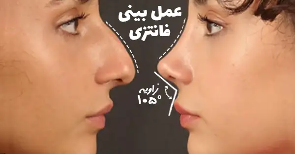 عکس عمل بینی