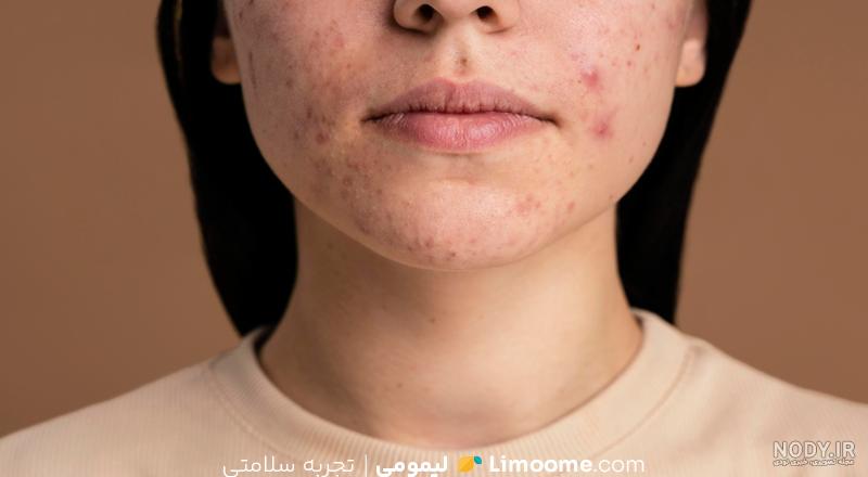 عکس گرمی صورت نوزاد