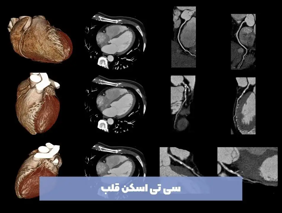 اسکن هسته‌ای قلب؛ قبل و بعد از اسکن و پروسه گرفتن عکس رنگی از قلب - متخصص  قلب و عروق در کرج