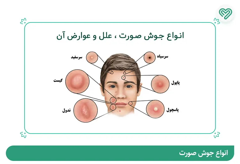 آشنایی با انواع جوش صورت (+تصویر) - طوبی مد مگ آشنایی با انواع جوش صورت (+تصویر) - طوبی مد مگ