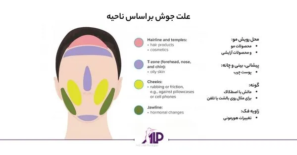انواع جوش بدن و روش درمان آن - انواع راهکار های از بین بردن جوش - آکادمی ایران اسکین کر انواع جوش بدن و روش درمان آن - انواع راهکار های از بین بردن جوش - آکادمی ایران اسکین کر
