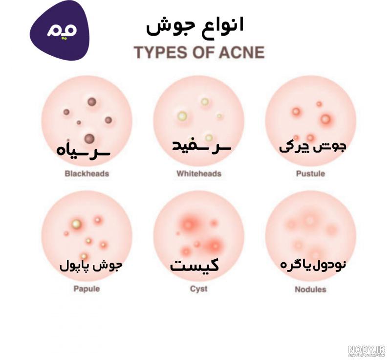 انواع جوش های صورت و درمان آن - کلینیک پوست و مو ساعی انواع جوش های صورت و درمان آن - کلینیک پوست و مو ساعی
