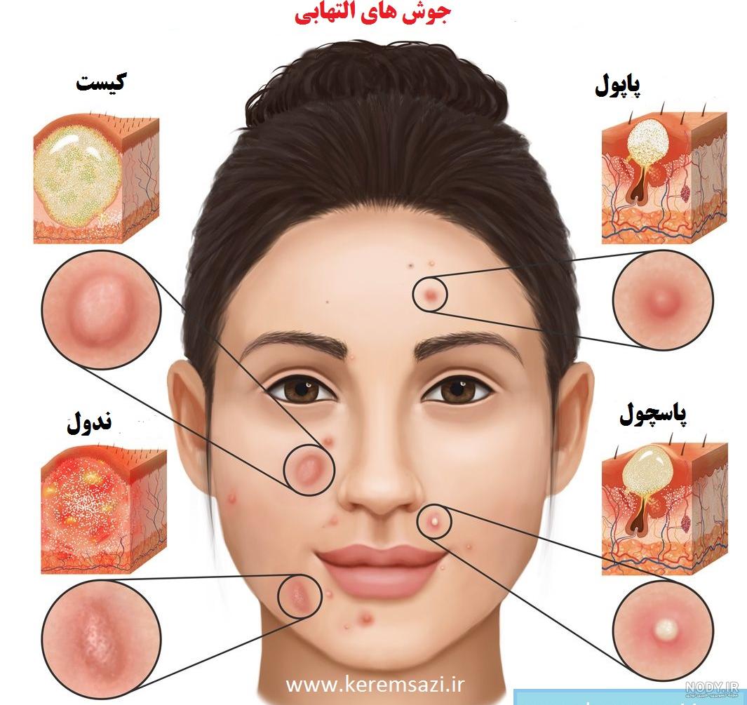 انواع جوش صورت و راهکارهای معجزه آسا برای درمان آن - کلینیک پوست و مو زیبایی ارومیه انواع جوش صورت و راهکارهای معجزه آسا برای درمان آن - کلینیک پوست و مو زیبایی ارومیه