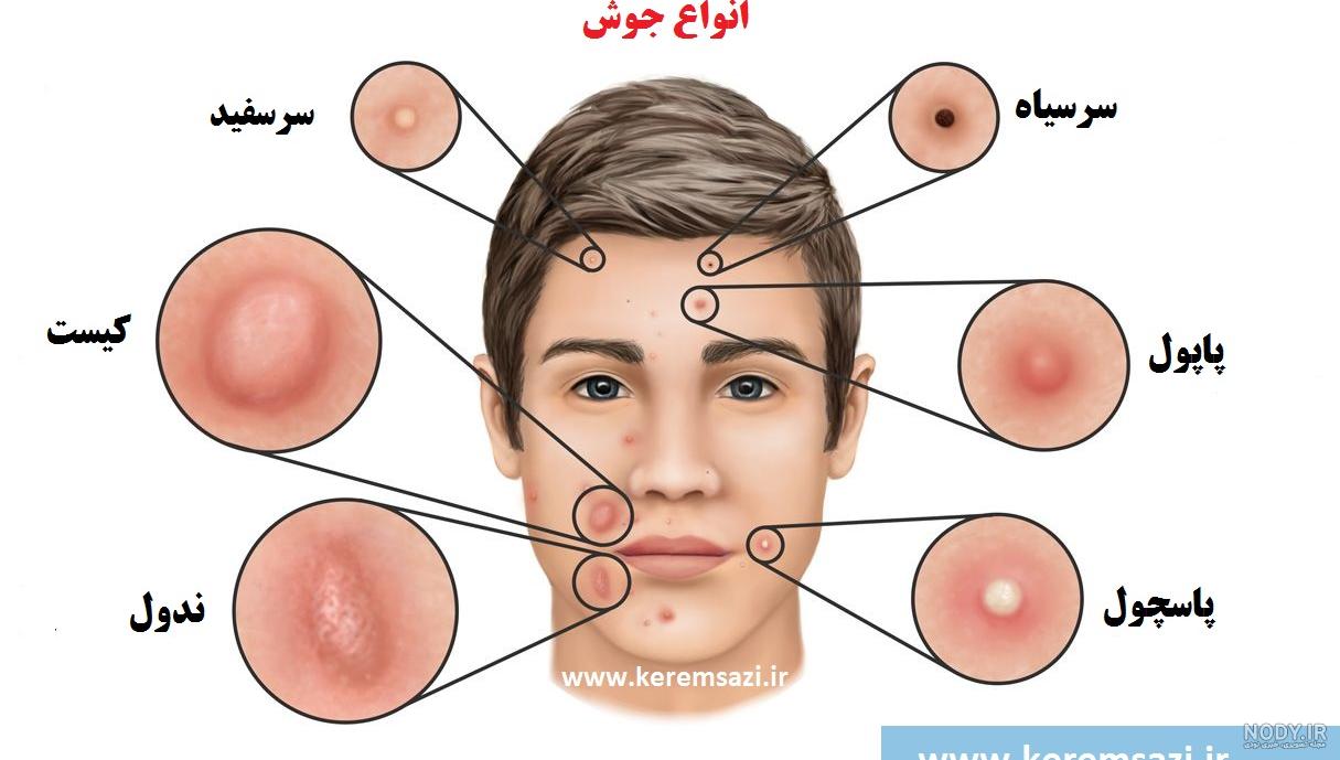 انواع جوش صورت و روش های درمان آن - همشهری آنلاین انواع جوش صورت و روش های درمان آن - همشهری آنلاین
