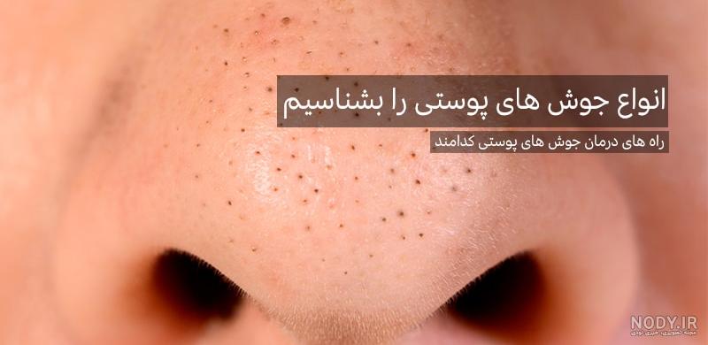 انواع جوش یا آکنه - دکتر مریم ملکی متخصص پوست و مو در اصفهان انواع جوش یا آکنه - دکتر مریم ملکی متخصص پوست و مو در اصفهان