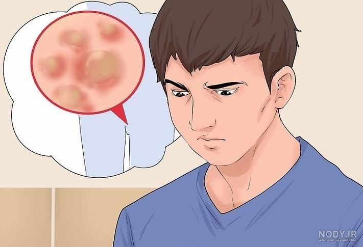 بیش از 10 روش خانگی و سنتی برای رهایی از شر جوش ناحیه تناسلی - عطاری آنلاین  سحرانا