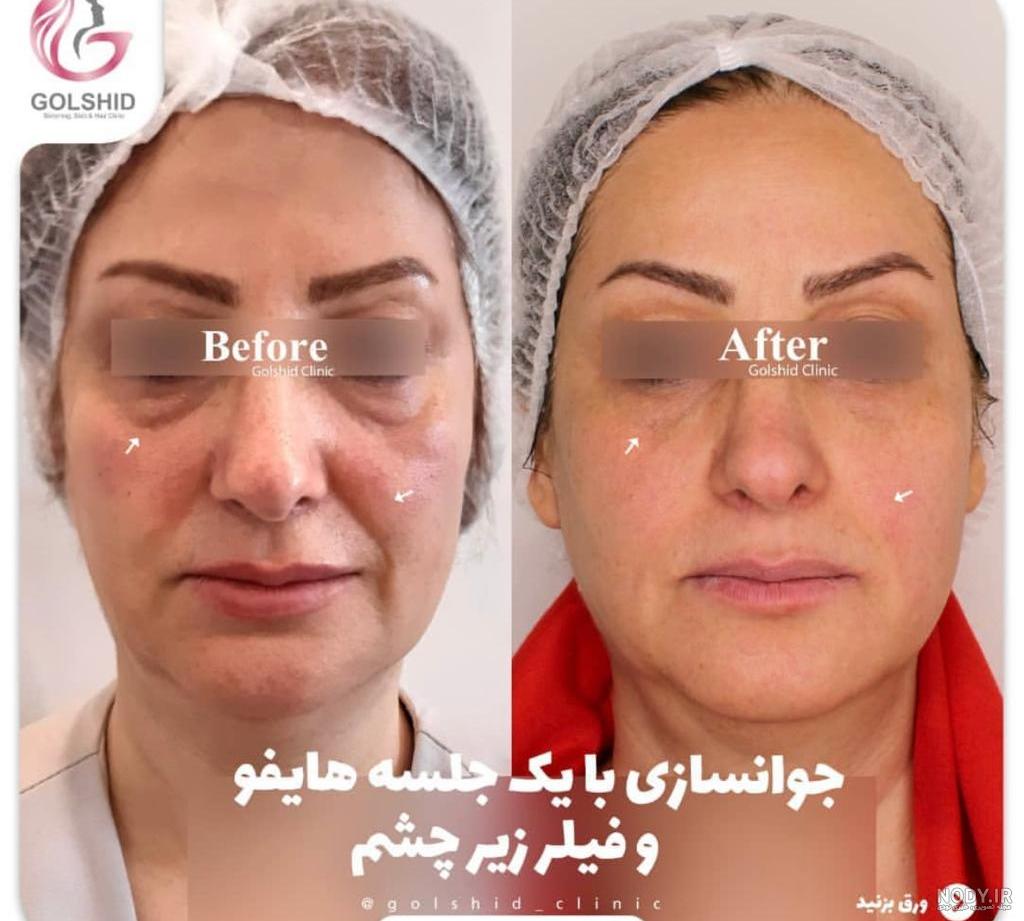 تزریق فیلر زیر چشم: ماندگاری، عوارض و ... | دکتر گیتا مجیدزاده تزریق فیلر زیر چشم: ماندگاری، عوارض و ... | دکتر گیتا مجیدزاده