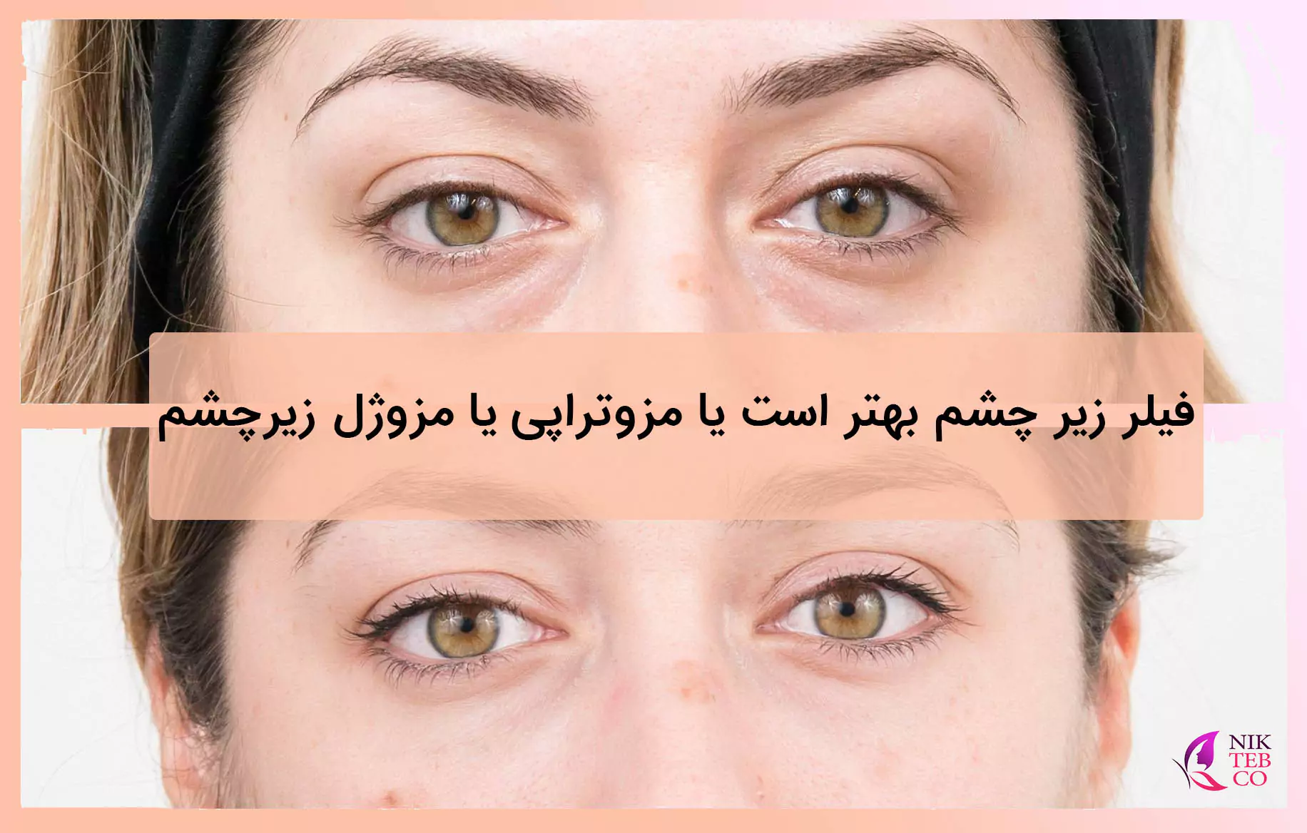 تزریق فیلر زیر چشم ❤️ماندگاری، عوارض + هزینه! | کلینیک دکتر تفت تزریق فیلر زیر چشم ❤️ماندگاری، عوارض + هزینه! | کلینیک دکتر تفت