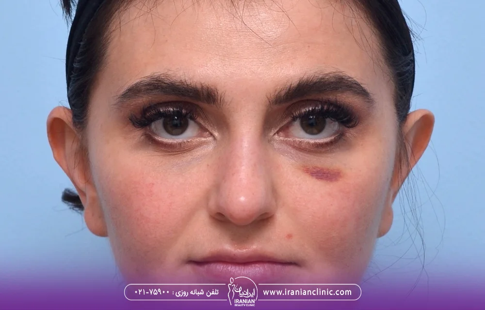 تزریق مزوژل زیر چشم و فواید تزریق آن تزریق مزوژل زیر چشم و فواید تزریق آن