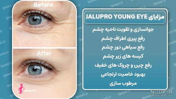 تزریق مزوژل زیر چشم چیست؟ بررسی مزایا و معایب و هزینه تزریق مزوژل زیر چشم چیست؟ بررسی مزایا و معایب و هزینه