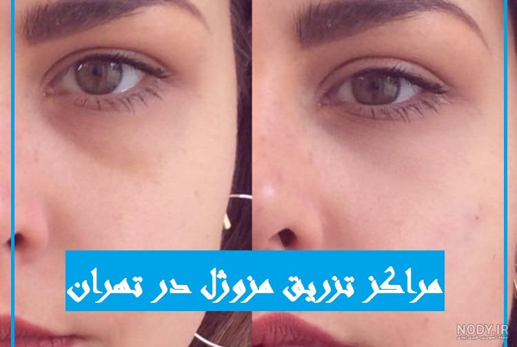 تزریق ژل به زیر چشم ❤️ + فیلم و عکس ✔️ مراحل تزریق ژل به زیر چشم | مرکز زیبایی و لیزر تزریق ژل به زیر چشم ❤️ + فیلم و عکس ✔️ مراحل تزریق ژل به زیر چشم | مرکز زیبایی و لیزر