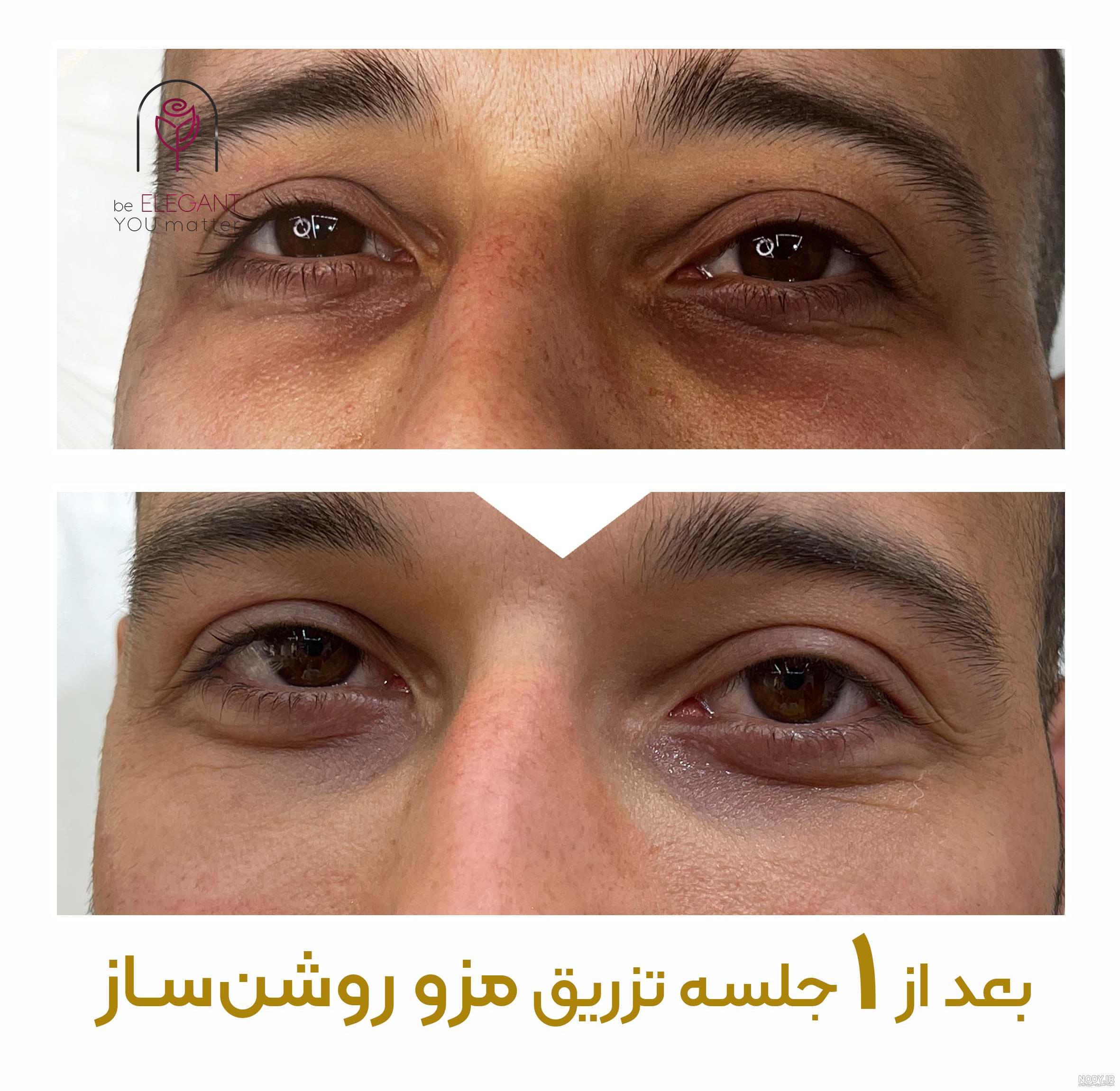 تزریق ژل زیر چشم روشی برای رفع گودی و سیاهی زیر چشم + عکس تزریق ژل زیر چشم روشی برای رفع گودی و سیاهی زیر چشم + عکس