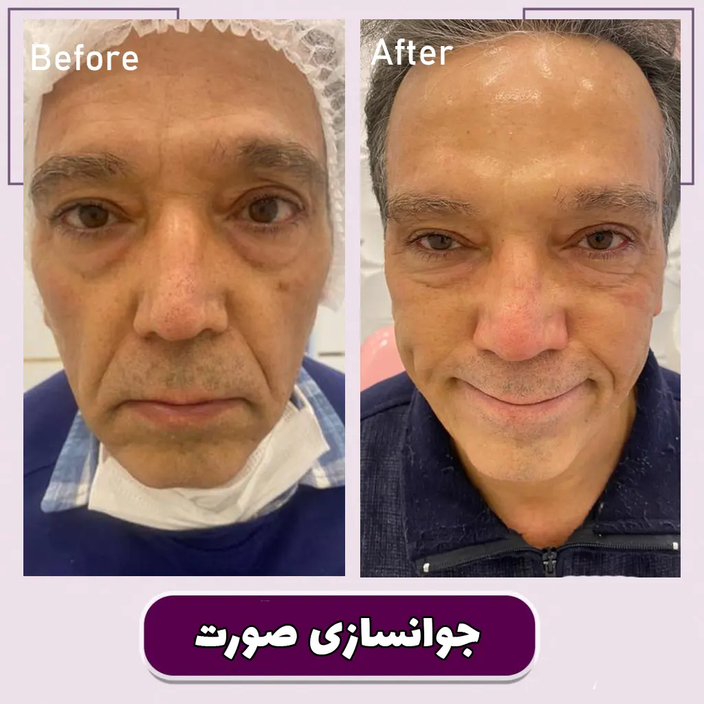 تزریق ژل و فیلر زیر چشم | عوارض، ماندگاری و قیمت — مجله زیبایی لیا تزریق ژل و فیلر زیر چشم | عوارض، ماندگاری و قیمت — مجله زیبایی لیا