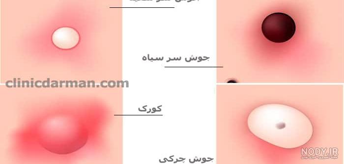 تفاوت جوش فعال، جوش سرسفید و جوش سر سیاه - کلینیک دلتا تفاوت جوش فعال، جوش سرسفید و جوش سر سیاه - کلینیک دلتا