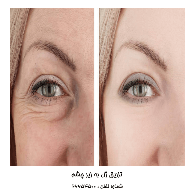 تفاوت مزوژل و مزوتراپی زیر چشم - کلینیک دلتا تفاوت مزوژل و مزوتراپی زیر چشم - کلینیک دلتا