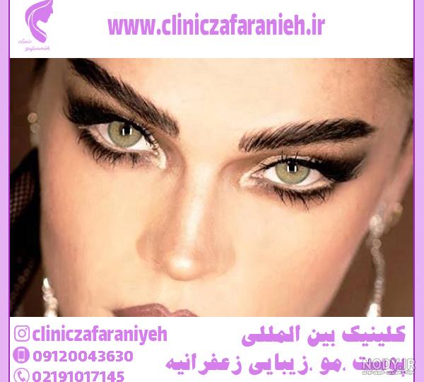 جراحی چشم گربه ای | فوق تخصص جراحی پلاستیک | دکتر عطاالله حیدری