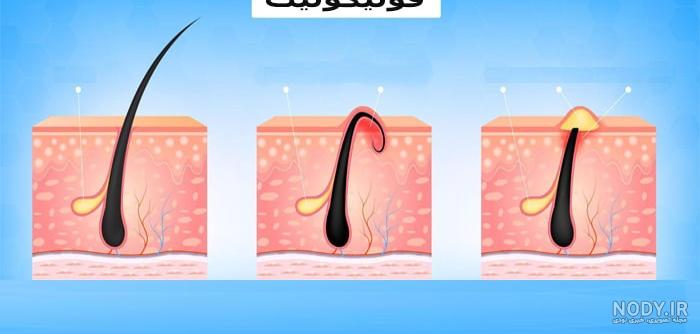 جوش تناسلی - تفاوت جوش و تبخال تناسلی- خطرات جوش چرکی در ناحیه تناسلی |  دکتر انتظاری